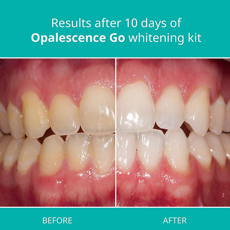 Opalescence Go 10% Pre Filled Teeth Whitening Trays Hydrogen Peroxide - Ванночки для отбеливания зубов перекисью водорода — изображение 7